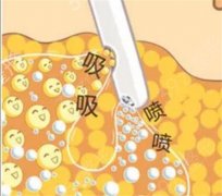吸脂到底好不好